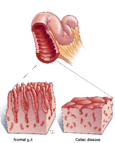 celiachia